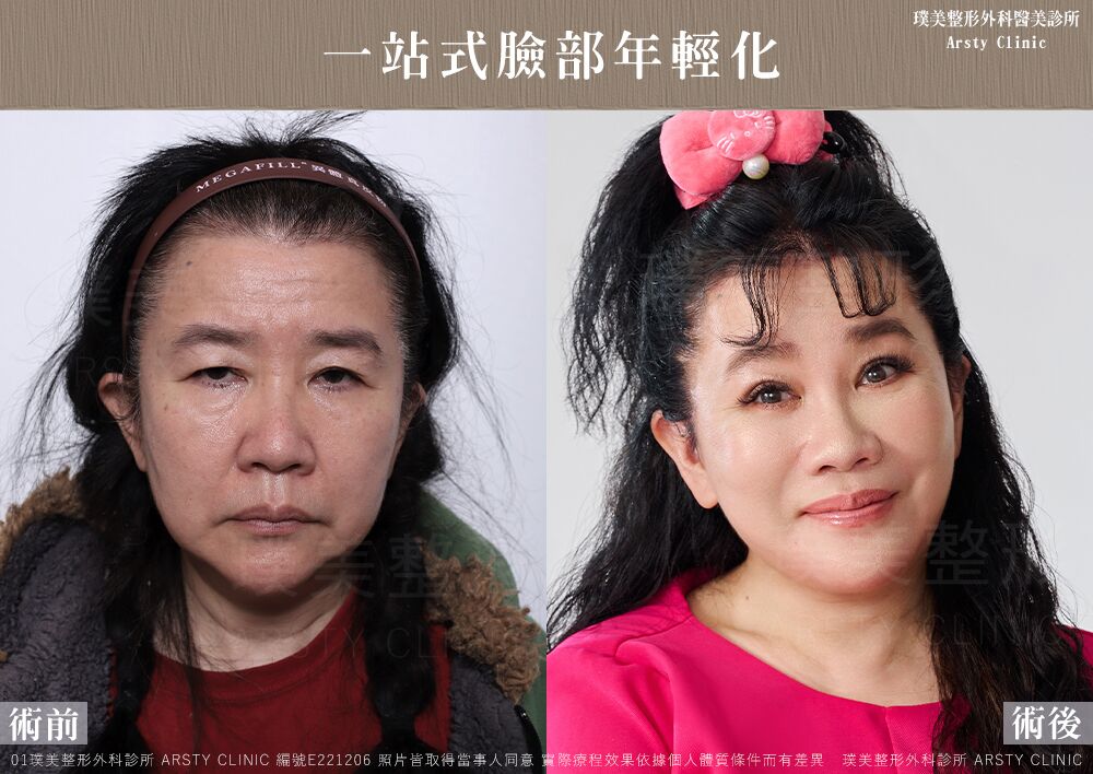 全臉拉皮 雙眼皮重修 眼袋外開 臉部補脂 臉部抽脂 E221206 BA 術後03