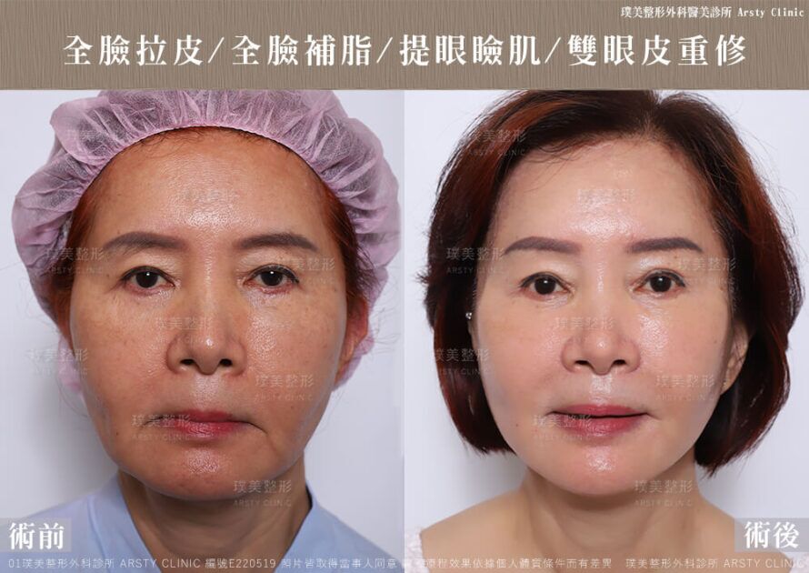 全臉拉皮 全臉補脂 提眼瞼肌 雙眼皮重修 E220519 01
