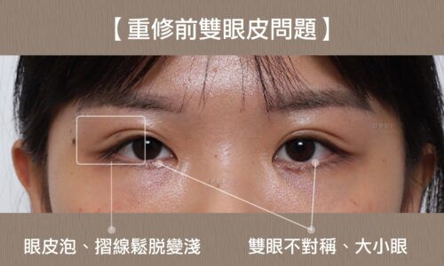 割雙眼皮重修-C221028BA_01 割雙眼皮重修-C221028BA_01
