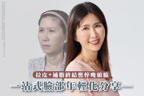 封面 提眉 中臉拉皮 雙眼皮重修 眼袋外開 臉部補脂 臉部年輕化 E220705
