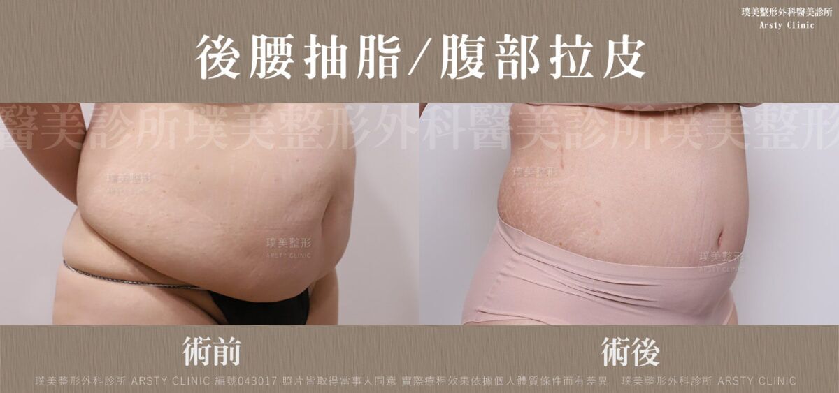 後腰抽脂、腹部拉皮 BA 043017 局