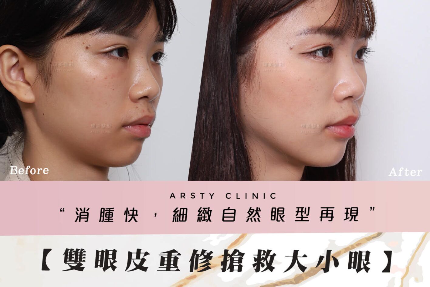 案例封面all65割雙眼皮重修-C221028BA 案例封面all65