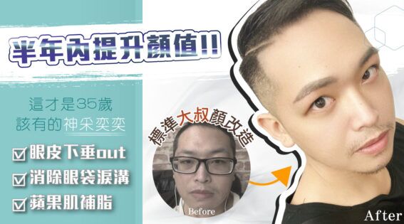 眉切 眼袋內開 蘋果肌淚溝D120723封面