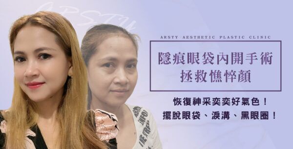 璞美眼袋手術分享心得