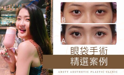 精選案例封面_眼袋手術