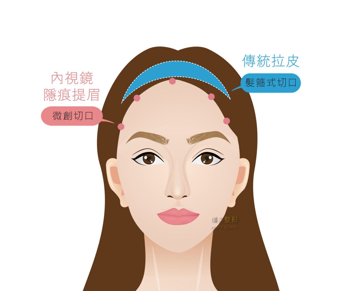 內視鏡提眉手術切口及傳統拉皮手術切口大小比較