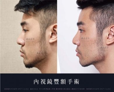內視微創鏡豐額價格豐額推薦內視微創鏡豐額後遺症內視微創鏡豐額權威內視微創鏡豐額手術余德毅醫師荊偉政醫師璞美醫美隆內視微創鏡豐額療程內視微創鏡豐額恢復期內視微創鏡豐額消腫內視微創鏡豐額多久後恢復自然內視微創鏡豐額價錢內視微創鏡豐額失敗內視微創鏡豐額風險內視微創鏡豐額疤痕內視微創鏡豐額後遺症內視微創鏡豐額ptt推薦、內視微創鏡豐額台北、內視微創鏡豐額dcard推薦