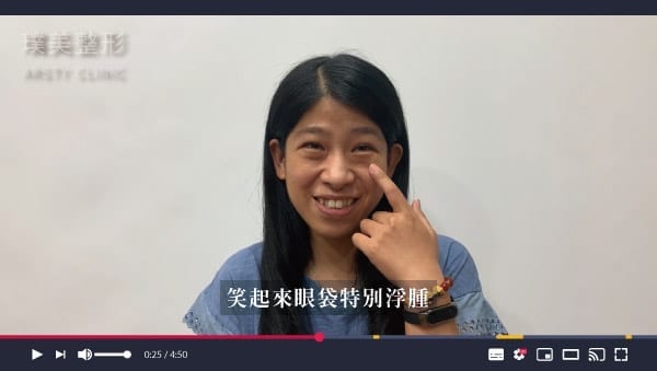 眼袋內開_自體臉雕_蘋果肌_淚溝-C220529-01 眼袋內開_自體臉雕_蘋果肌_淚溝-C220529-01