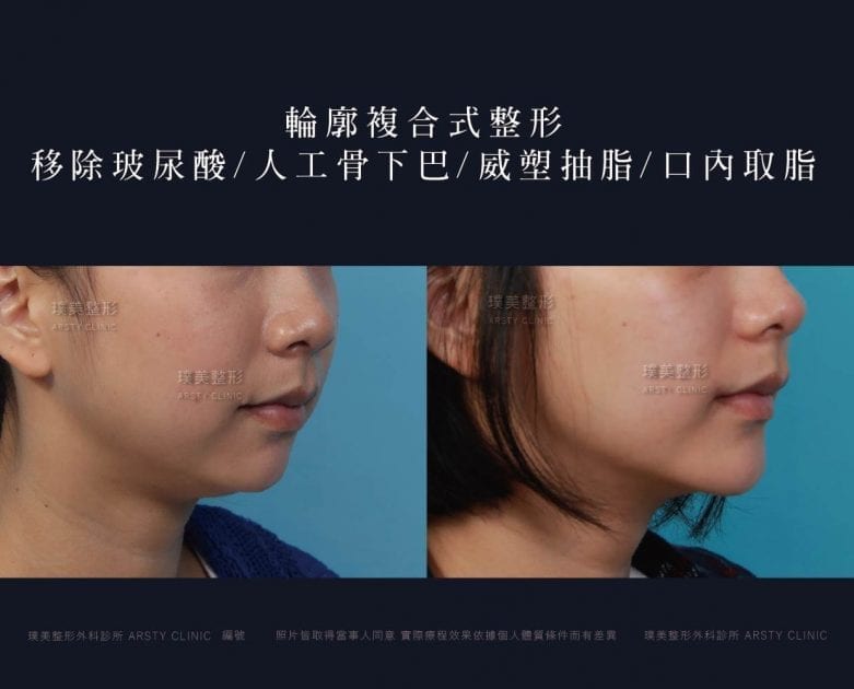 下巴手術.墊下巴手術.人工骨下巴
