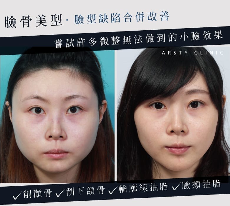 201909_削骨下巴抽脂_客製精算完美弧線_1 201909 削骨下巴抽脂 客製精算完美弧線 1