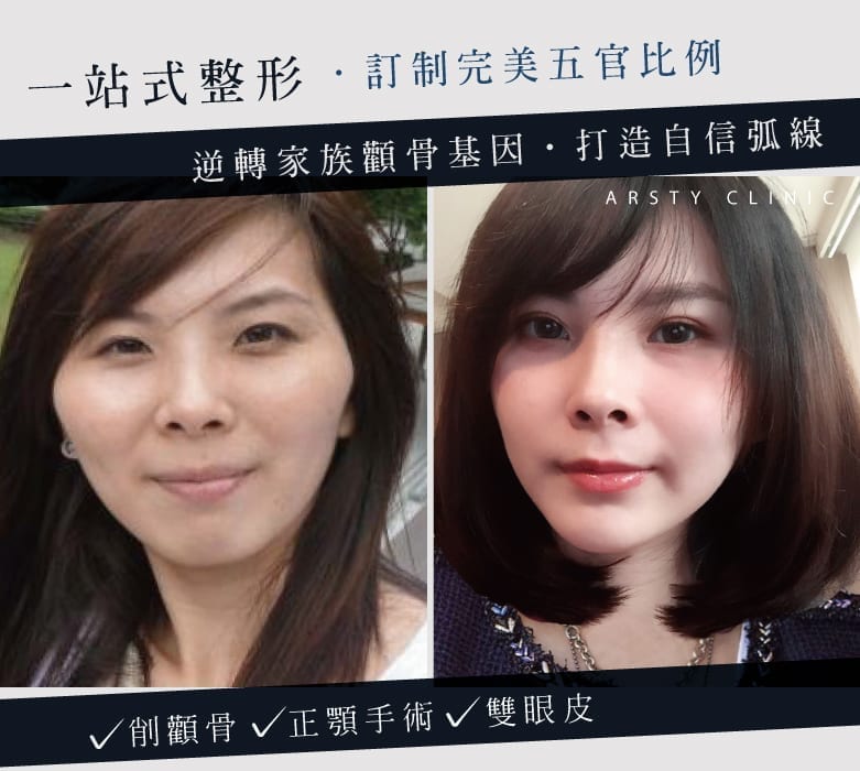 201909_削骨下巴抽脂_客製精算完美弧線_5 201909 削骨下巴抽脂 客製精算完美弧線 5