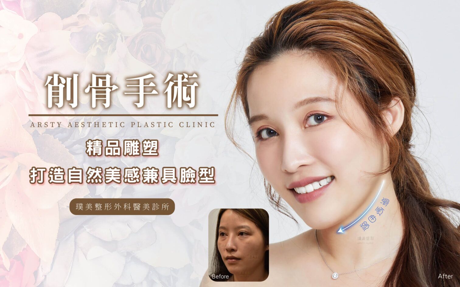削骨手術Banner N削骨Banner