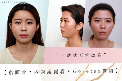 顴骨內推削骨內視鏡提眉豐額