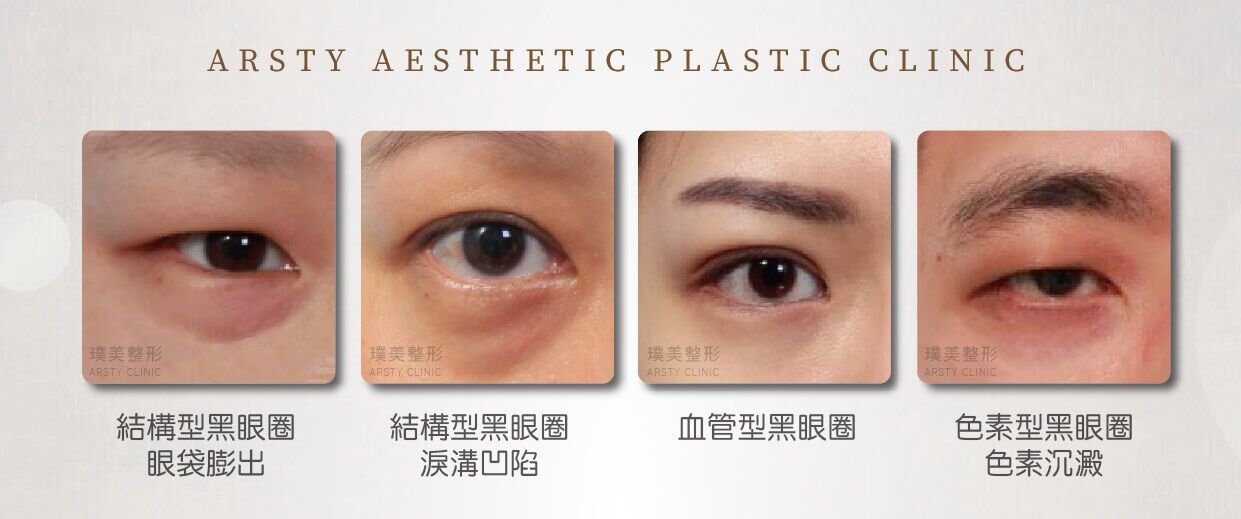 黑眼圈 結構型黑眼圈及色素型黑眼圈和血管型黑眼圈