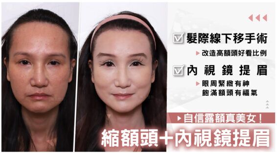D220702髮際線 banner 04